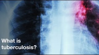What is tuberculosis?