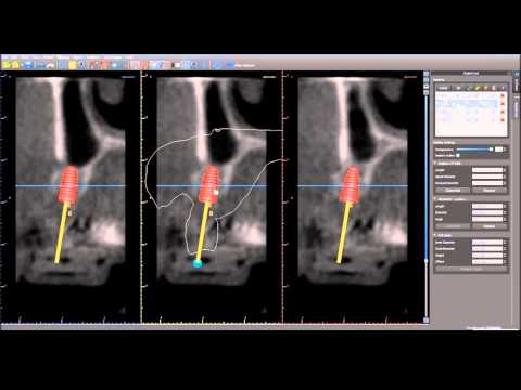 GSS Webinar - Case SS #4,5,7 - Temp. Bridge