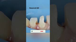 🤑🤑Tooth Filling v/s tooth Restoration | Case 24 | Your Dentist | #shots #shortvideo #shorts #short
