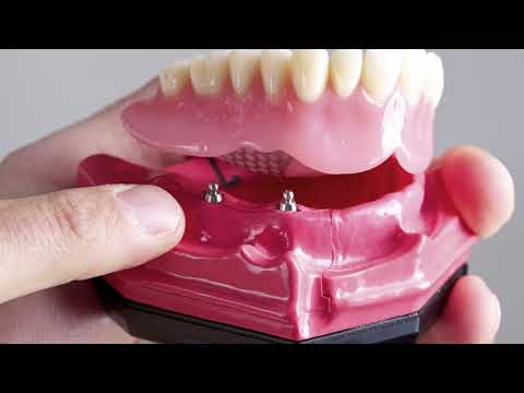 FAQ Benefits of implant retained dentures