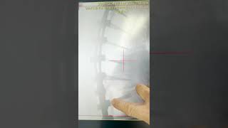Thoracic Spinal Fusion