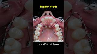 Braces, change your smile #braces #orthodontist #dentist