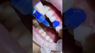 #dentalcare #altrincham #dentist #dentalclinic #dentalgram #veneers #veneers_smile #manchester