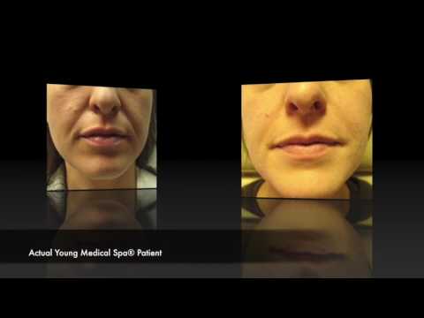 Podcast Episode 10 Tell Me About Fillers