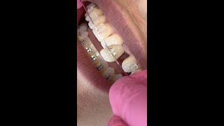Front Tooth Falls Out With Braces!?!? 😳 Orthodontist Reacts