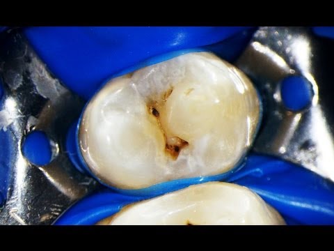 Лечение кариеса под микроскопом [caries treatment under microscope]