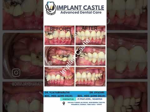 Full Mouth Rehabilitation #bestdentist #dentist #bestdentistnearme #aiims #dental #dentalimplant