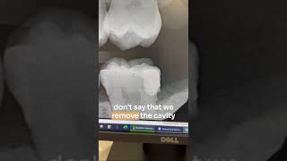 Told you need a root canal? Not so fast... #shorts