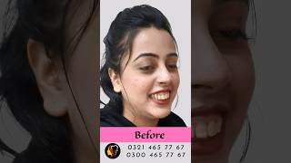 Gummy Smile Treatment | Amazing Transformation | Aldaim Dental Center #gummysmile #smilemakeover