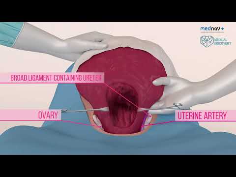 How to perform a caesarean section and deliver babies in different positions at caesarean section