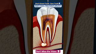 Root Canal Treatment | Save Tooth 🦷 #shorts #dentist #healthtips #viral