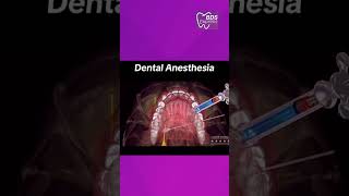 Dental Anesthesia #dentist #dental #dentalstudents #anesthesia #dentistry