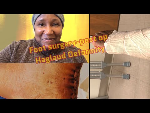 Post Surgery- Achilles recovery#haglaud’sdeformity#footsurgery#recovery#achillestendon