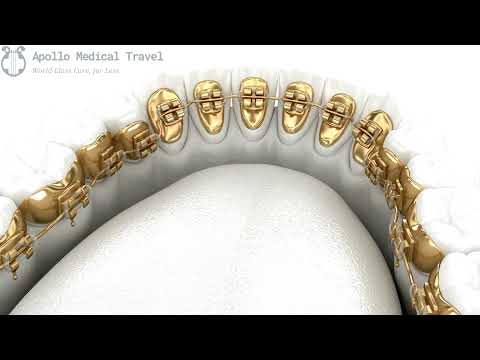 Animated Lingual Braces | Apollo Medical Travel