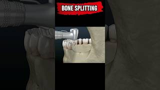Bone Splitting #Shorts #bonesplitting #dental #dentalcare #dentistry #dentalwork #dentalhygiene