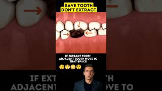 Don't Extract Tooth🦷😬 Save Tooth #shorts #youtubeshorts #tooth #dentist
