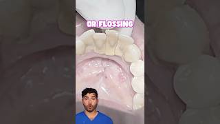 Teeth Cleaning Explained !?