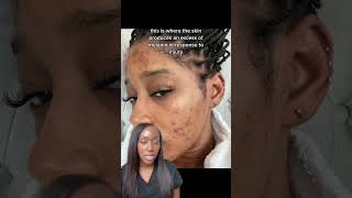 Types of Hyperpigmentation