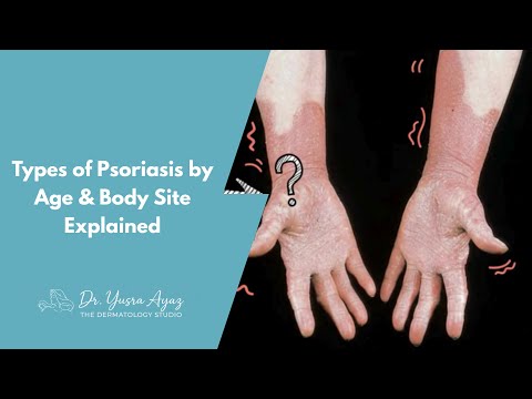 Lecture 3: Types of Psoriasis by Age & Body Site Explained
