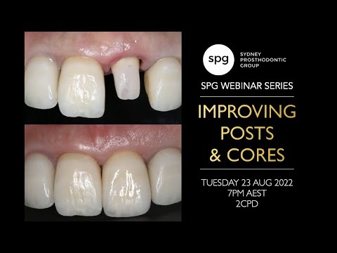 SPG Webinar: Improving Posts & Cores