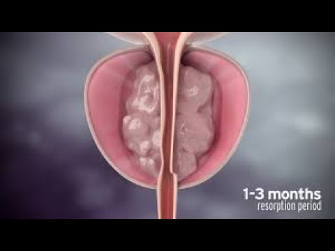 Rezum treatment for Enlarged Prostate