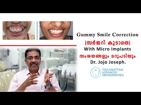 Gummy Smile Correction with Micro Implants - Questions and Answers By Dr. Jojo Joseph