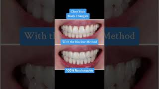 Close Your Black Triangles With the Bioclear Method 100% Non Invasive