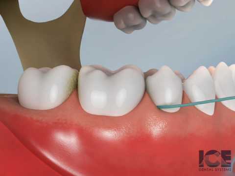 Flossing Lower Teeth