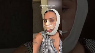 Reaching My 30s with a Glow Up: Nose Surgery Recovery Journey#GlowUpEra #NoseSurgery