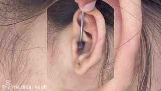 Earwax Removal Secrets STOP Using Q Tips