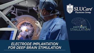 How Do They Implant The Electrode For Deep Brain Stimulation?