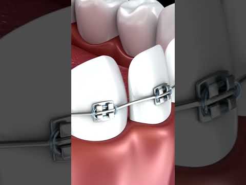 Animated Wire Braces Procedure