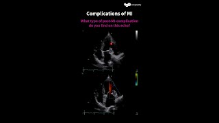 What type of post-MI-complication do you find on this echo?