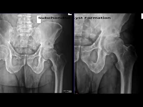 Dr Germanuel Landfair Explains A Hip X Ray