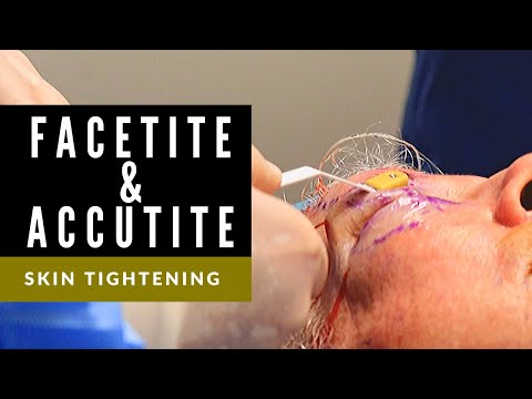 Skin Tightening of Face with FaceTite & AccuTite | Center Valley, PA | Young Medical Spa
