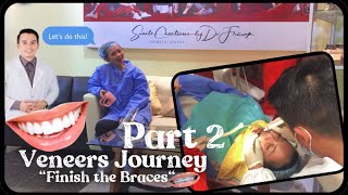 Veneers Journey @SmileCreation by Dr.Frank | Part 2 (Finish the Braces) | Pinkrose Marie Pesole