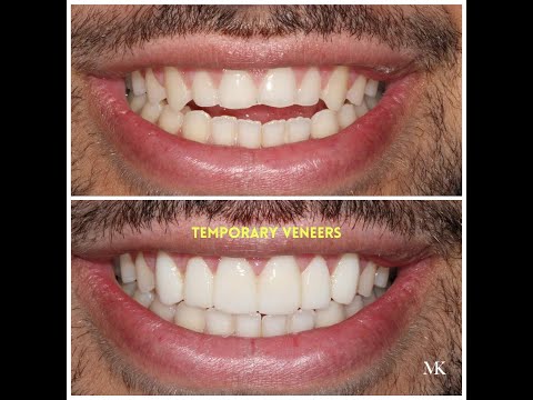 My Smile Transformation Journey: Temporary Veneers to New Smile Preview