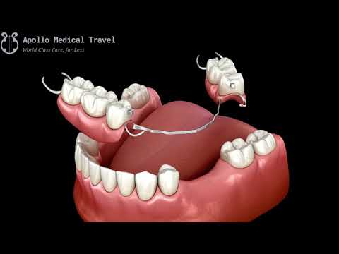 Animated Removable Partial Dentures | Apollo Medical Travel
