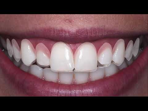 Smile Design