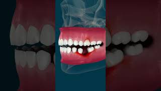 What REALLY Happens When You Lose a Tooth #dentalimplants #balham #eastfinchley #teeth #health