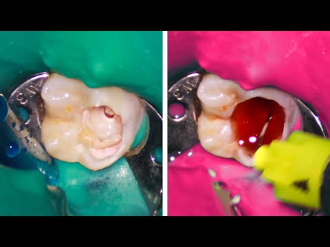 Root Canal Treatment: The Secret to Saving Your Tooth!