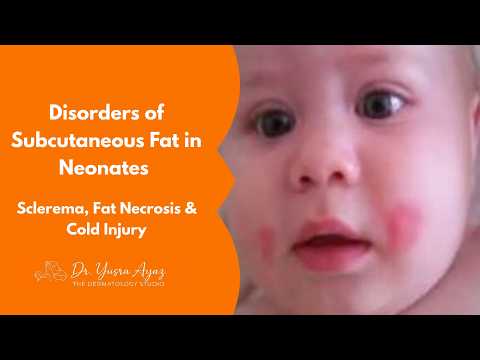 Lecture 4: Disorders of Subcutaneous Fat in Neonates, Sclerema, Fat Necrosis & Cold Injury