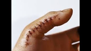 Exploration of penetrating wound CPT code - simplify medical coding