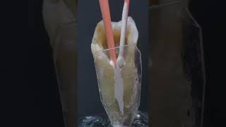 Root Canal Treatment London