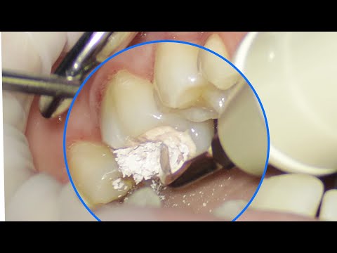 What's hiding under a dental filling? Dentist reveals the truth