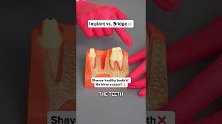 Implant vs. Bridge 🦷 Which one’s really better? 🤔