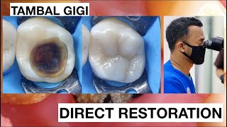 Dental Filling Composite Direct Restoration Upper Molar | General Dentist Griya RR