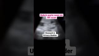 Baby parts seen during NT scan  #pregnancyadvice #ntscan #pregancyultrasound #pregnancycare