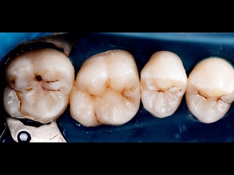 Реставрация зуба [ Tooth restoration] 2016