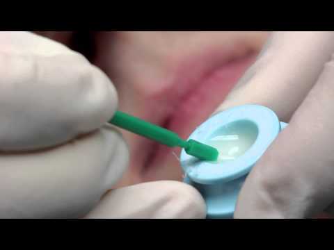 Topical Fluoride
